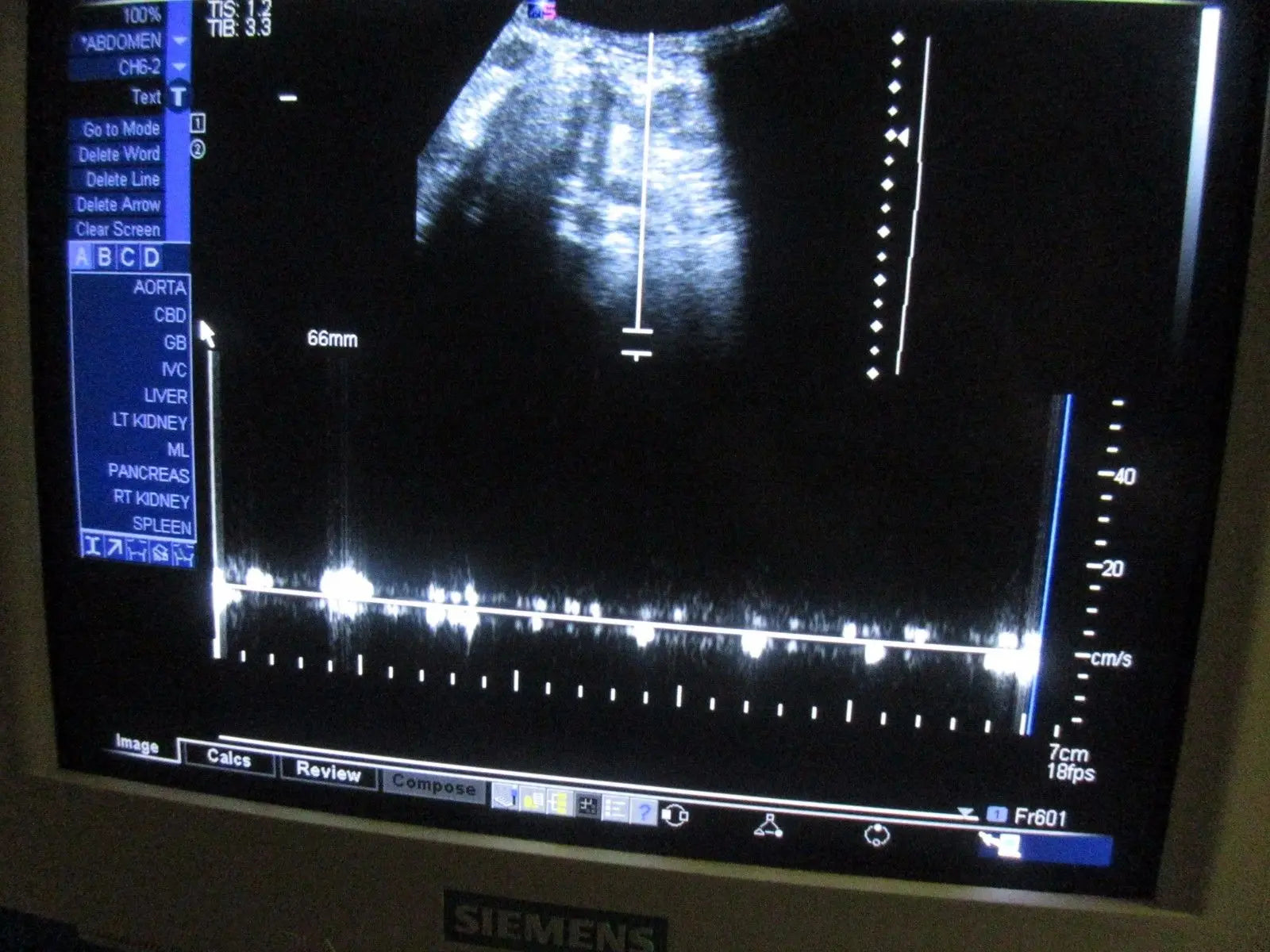 Siemens Sonoline Antares ver 3.5 Ultrasound TESTED by Certified Ultrasound Tech DIAGNOSTIC ULTRASOUND MACHINES FOR SALE