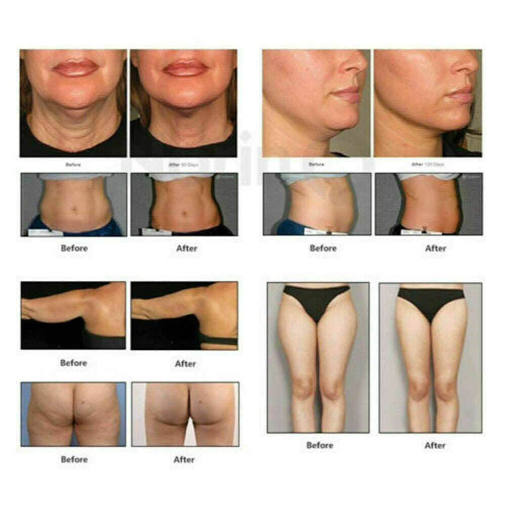 High Intensity Focused Ultrasound HIFU Face Body Lifting Tightening Machine Home DIAGNOSTIC ULTRASOUND MACHINES FOR SALE