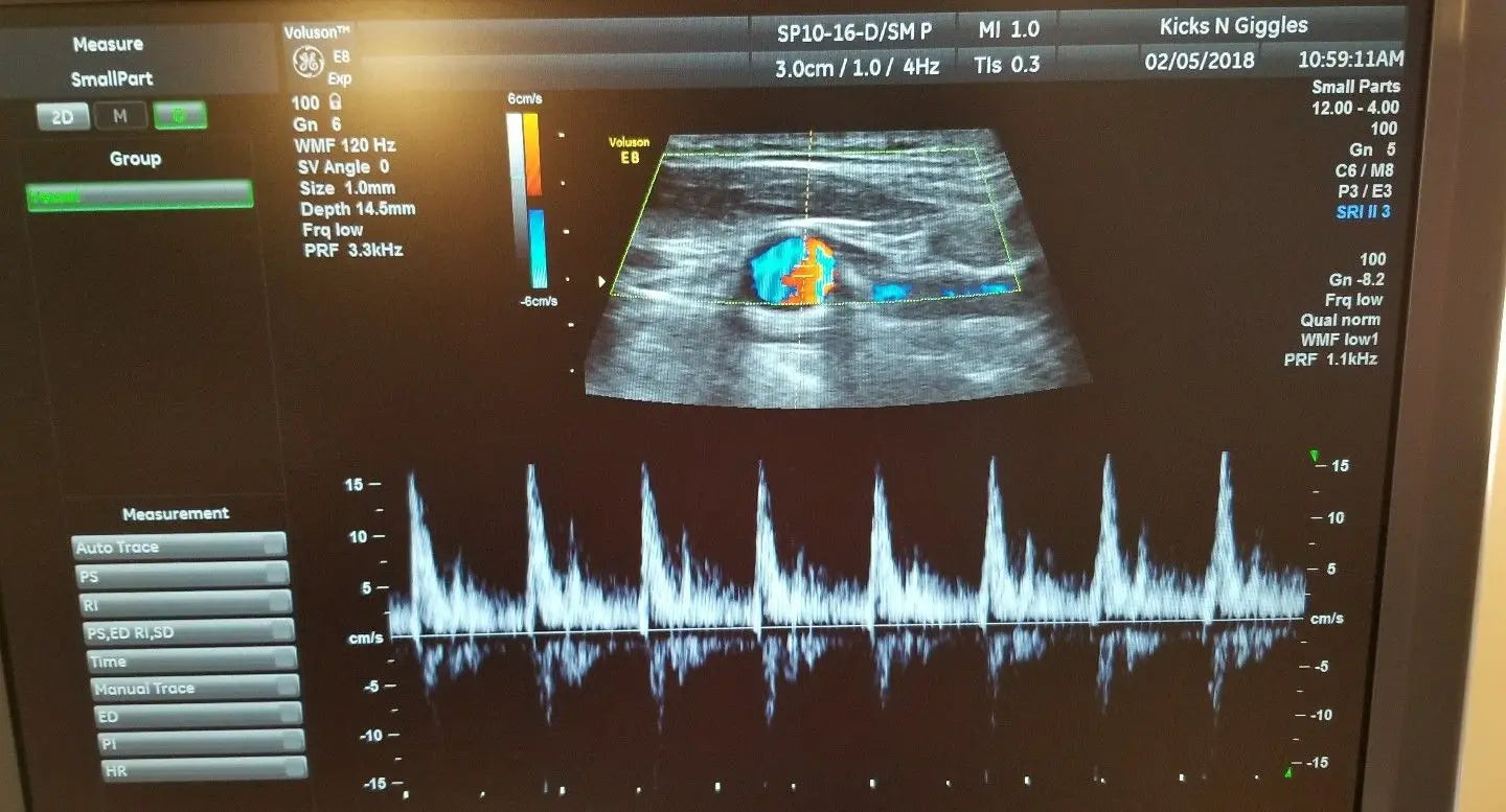GE SP10-16-D Ultrasound Probe / Transducer DIAGNOSTIC ULTRASOUND MACHINES FOR SALE