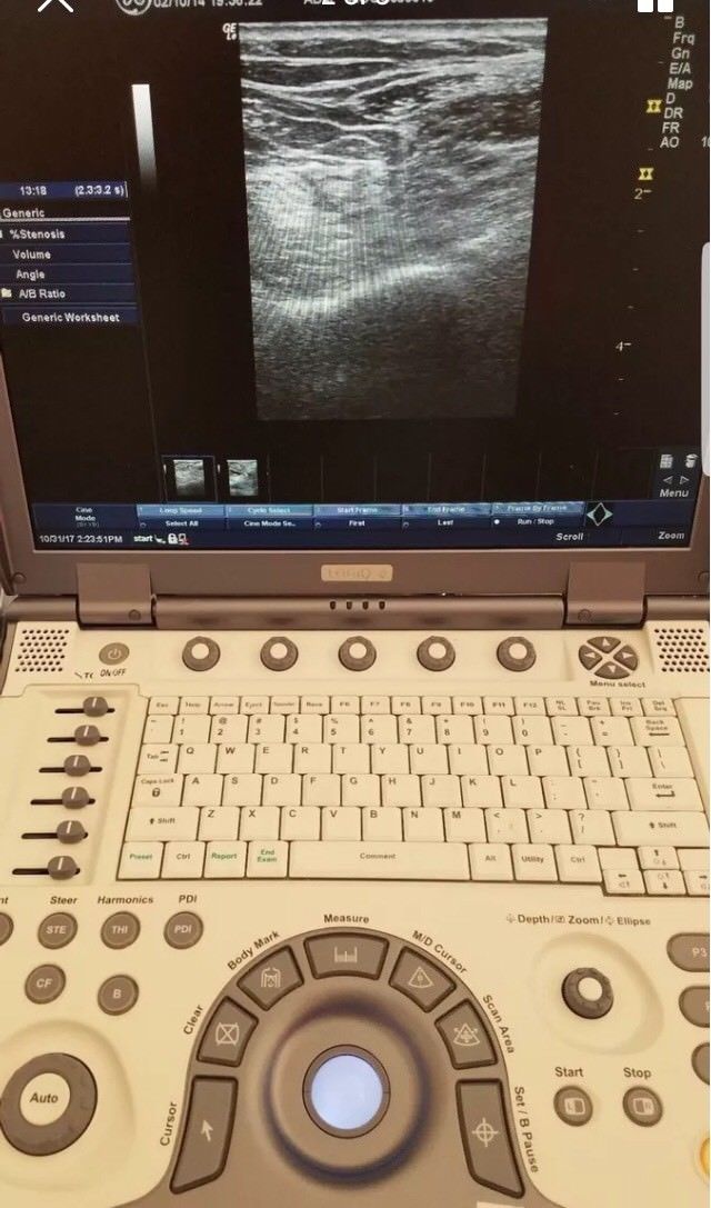 GE Logiq E 2007 Portable Ultrasound DIAGNOSTIC ULTRASOUND MACHINES FOR SALE