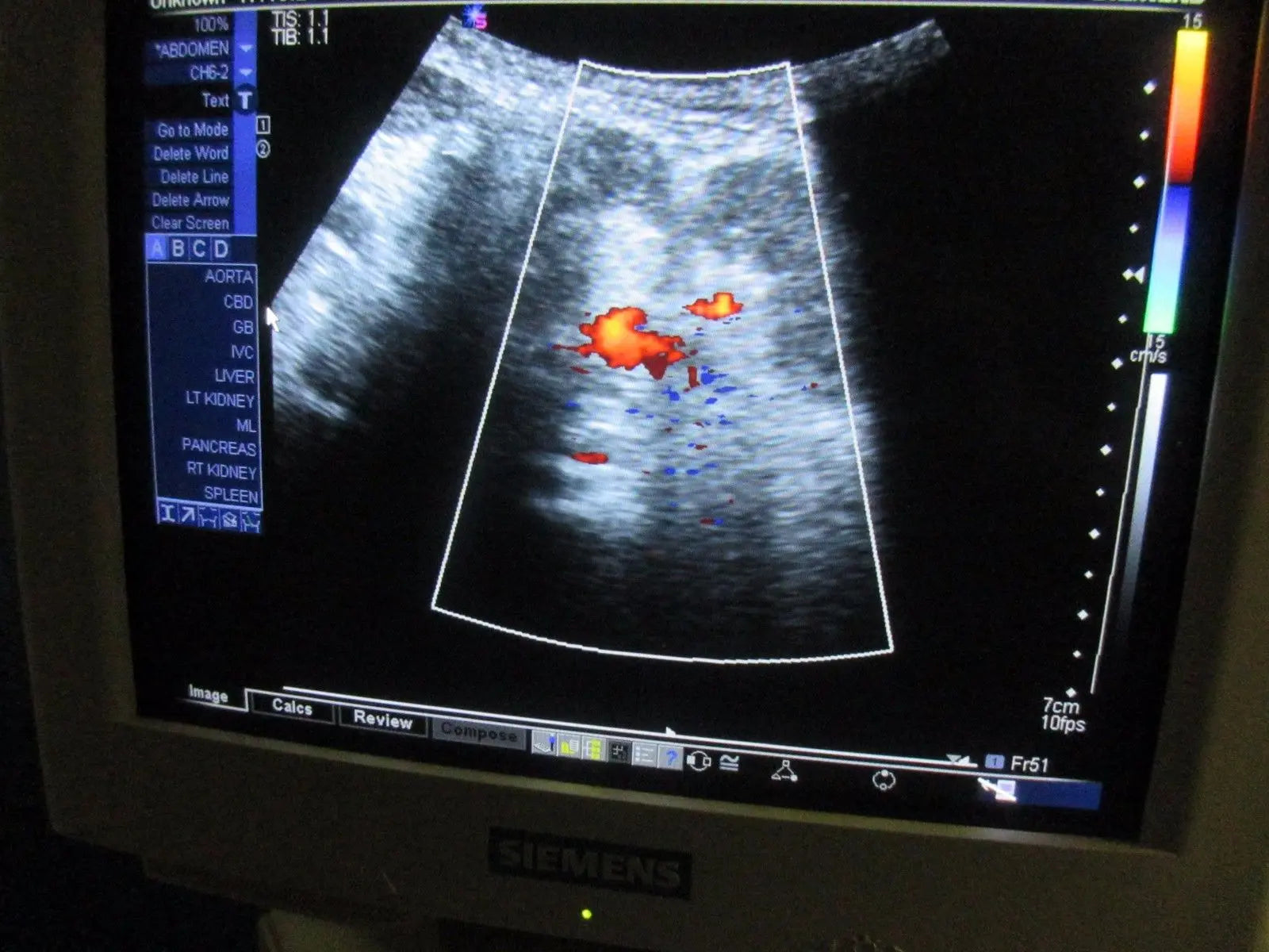 Siemens Sonoline Antares ver 3.5 Ultrasound TESTED by Certified Ultrasound Tech DIAGNOSTIC ULTRASOUND MACHINES FOR SALE