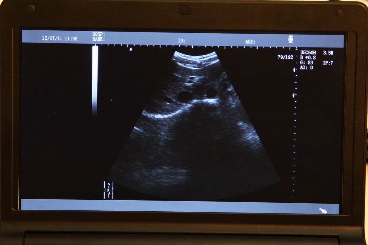 10.1'' Digital Portable Ultrasound Scanner/Machine Convex+Linear 2 Probes Sale DIAGNOSTIC ULTRASOUND MACHINES FOR SALE