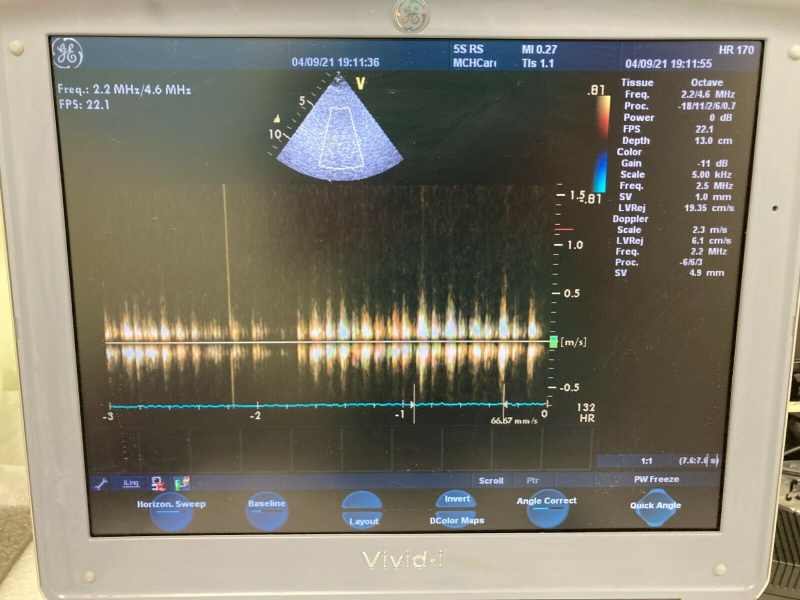 GE VIVID I BTO6 PORTABLE ULTRASOUND MACHINE WITH 3 PROBES and Cart. DIAGNOSTIC ULTRASOUND MACHINES FOR SALE
