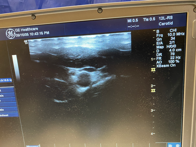 GE LOGIQ E Portable Ultrasound & phased array cardiac probe 6S-RS-Refurbished DIAGNOSTIC ULTRASOUND MACHINES FOR SALE