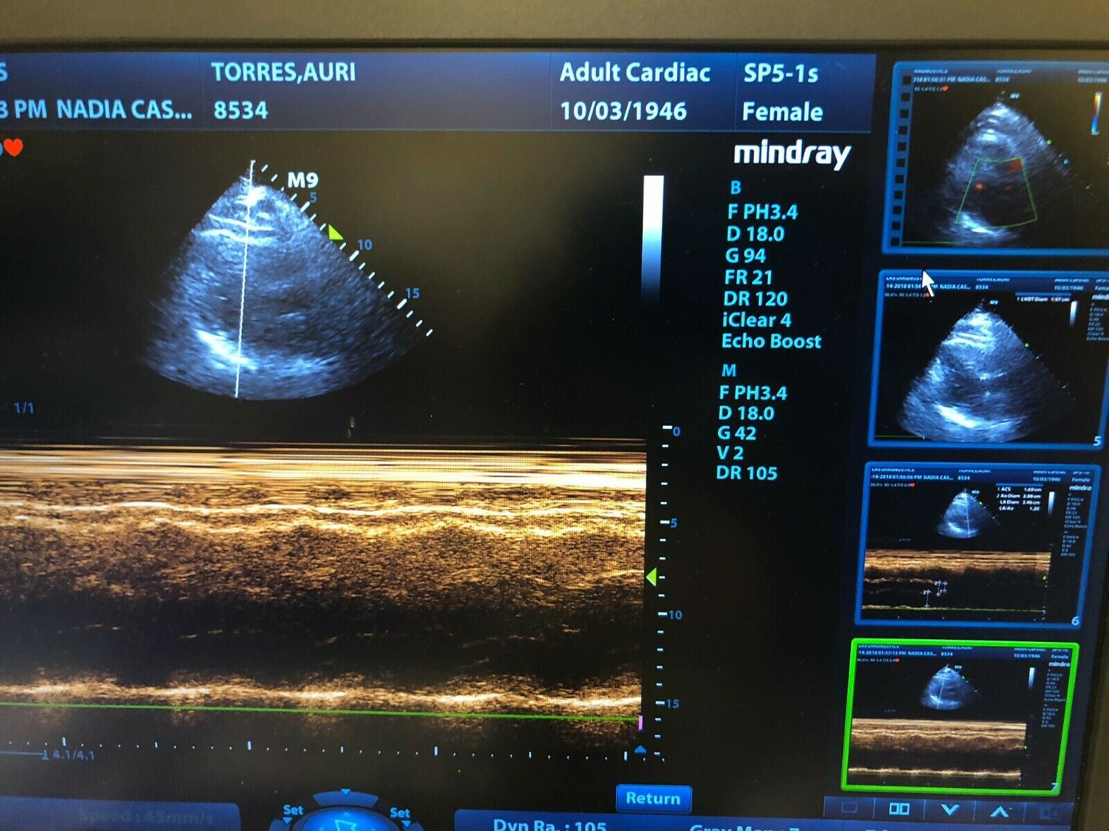 Mindray M9 Portable Ultrasound With  Two Probes (L12-4S) (C5-1S) DIAGNOSTIC ULTRASOUND MACHINES FOR SALE