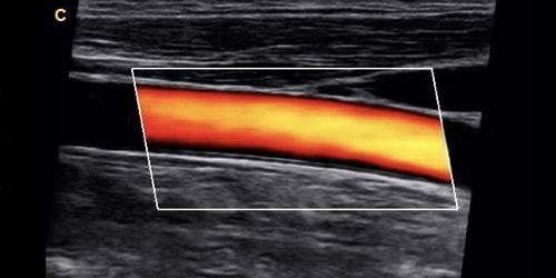 Chison Ebit 30 Color Doppler Ultrasound Scanner with Linear Array Probe 7-18MHz DIAGNOSTIC ULTRASOUND MACHINES FOR SALE