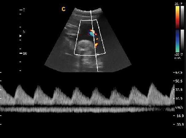 Chison Ebit 30 Color Doppler Ultrasound Scanner with Linear Array Probe 7-18MHz DIAGNOSTIC ULTRASOUND MACHINES FOR SALE