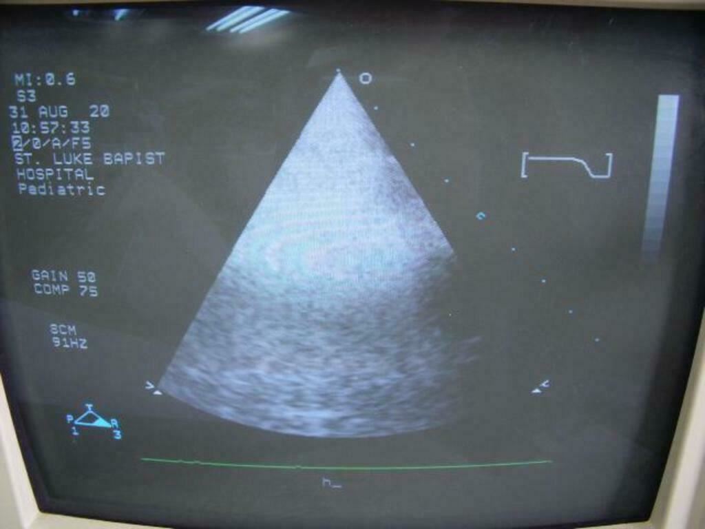 Philips 21311A S3 Ultrasound Probe | PR5323 DIAGNOSTIC ULTRASOUND MACHINES FOR SALE