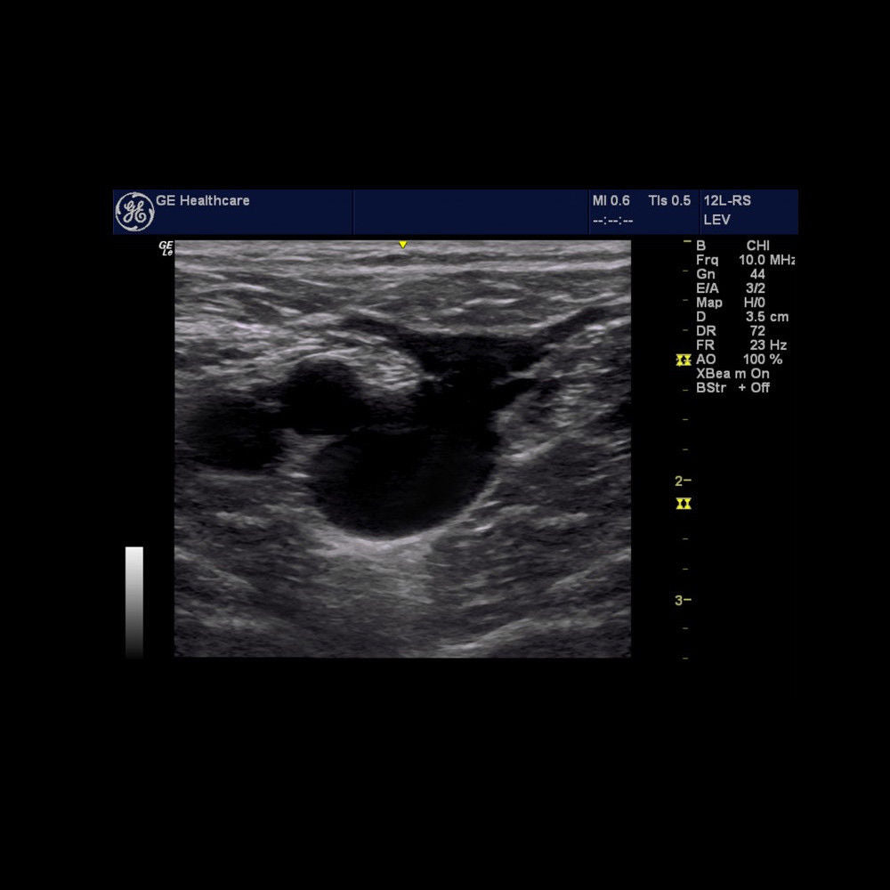 GE LOGIQ E Portable Ultrasound with E8C-RS Vaginal Transducer & Convex Probe DIAGNOSTIC ULTRASOUND MACHINES FOR SALE