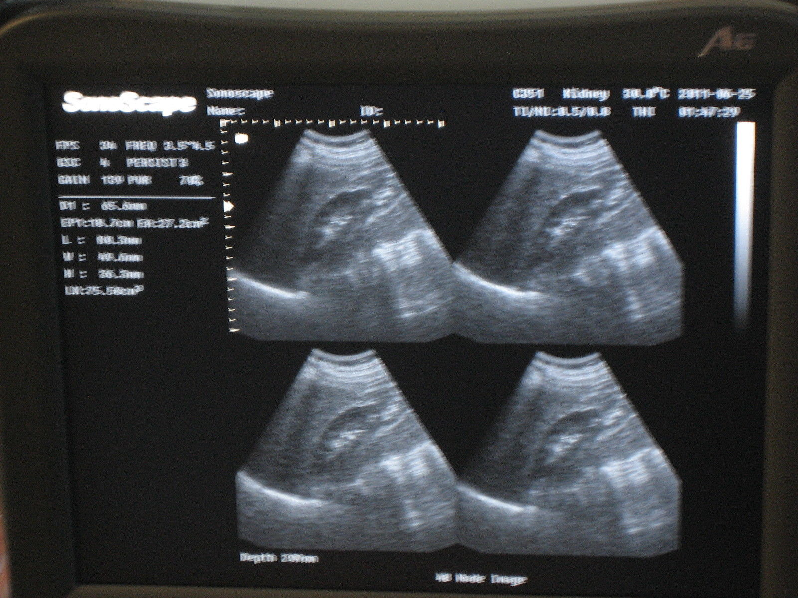 Ultrasound SonoScape A6 B/W  with convex and Endovaginal DIAGNOSTIC ULTRASOUND MACHINES FOR SALE