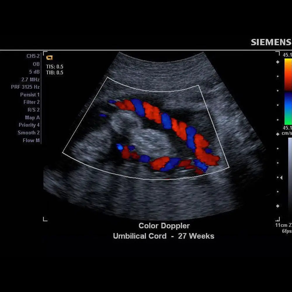 Pulsed Wave Ultrasound - Siemens X150 Machine + Acuson CH5-2 + THI + DICOM DIAGNOSTIC ULTRASOUND MACHINES FOR SALE