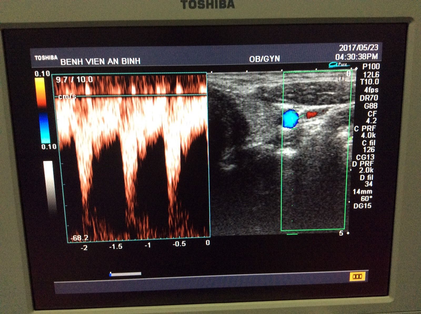 Toshiba Ultrasound transducer probe linear PLM-805AT DIAGNOSTIC ULTRASOUND MACHINES FOR SALE