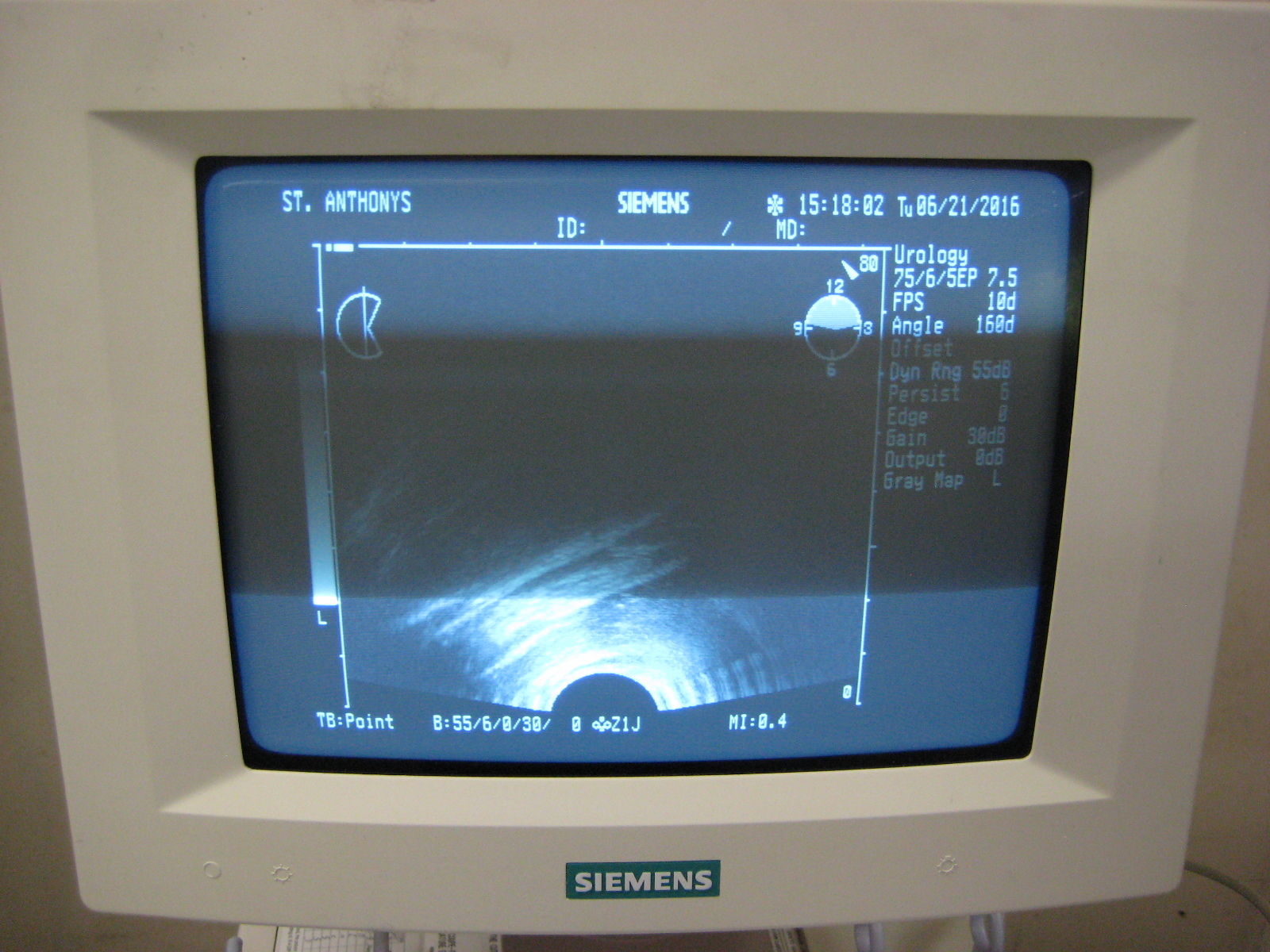 Siemens Sonolina Adara ultrasound w/ 1 probe, printer, guaranteed. DIAGNOSTIC ULTRASOUND MACHINES FOR SALE