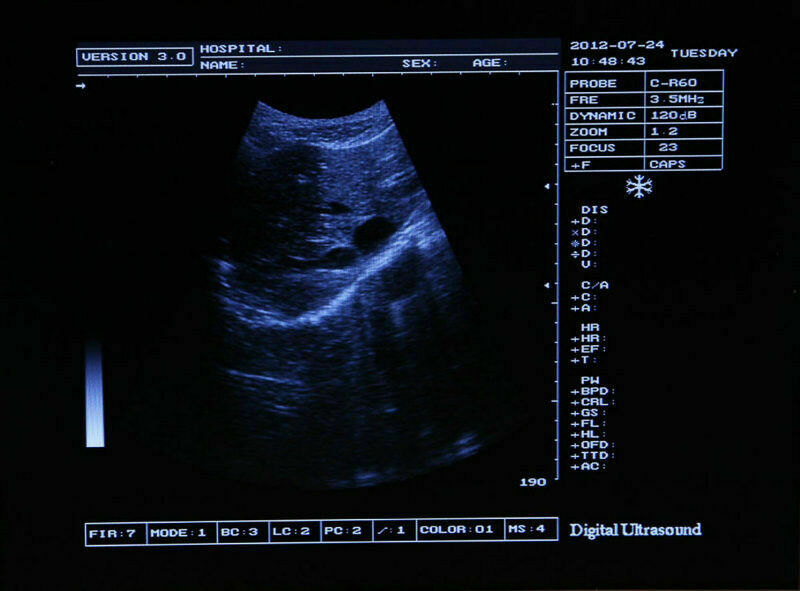 LCD Full Digital Portable Ultrasound Scanner Machine +7.5 Transvaginal Probe +3D DIAGNOSTIC ULTRASOUND MACHINES FOR SALE