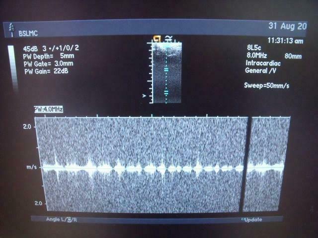 ACUSON 8L5 Ultrasound Transducer DIAGNOSTIC ULTRASOUND MACHINES FOR SALE