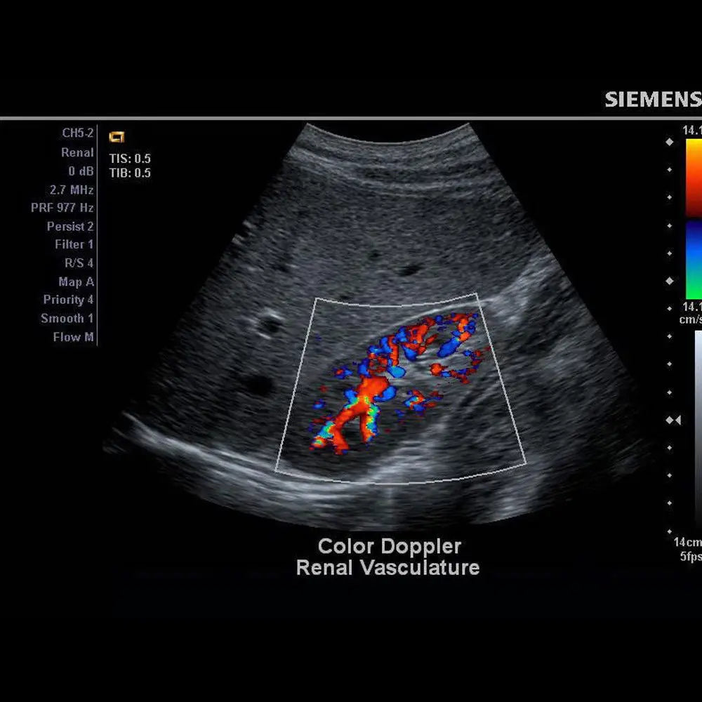 Pulsed Wave Ultrasound - Siemens X150 Machine + Acuson CH5-2 + THI + DICOM DIAGNOSTIC ULTRASOUND MACHINES FOR SALE