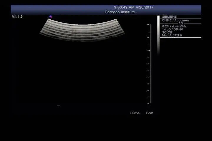 Siemens CH6-2 Ultrasound Probe DIAGNOSTIC ULTRASOUND MACHINES FOR SALE