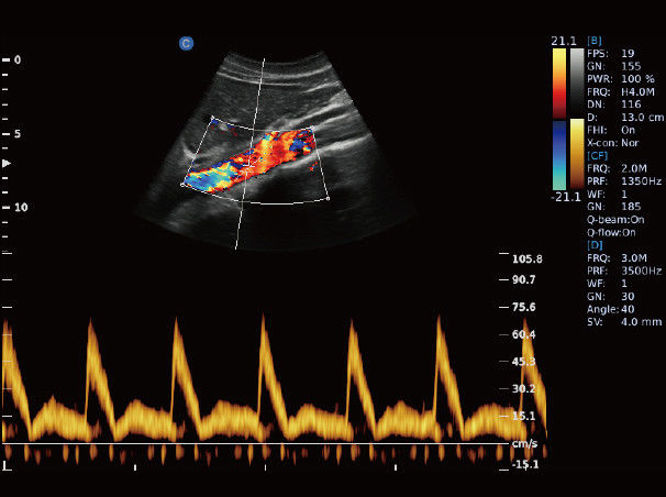 Chison eBit50 Ultrasound Color Doppler Portable Advanced 15" LED Battery 1 Probe DIAGNOSTIC ULTRASOUND MACHINES FOR SALE