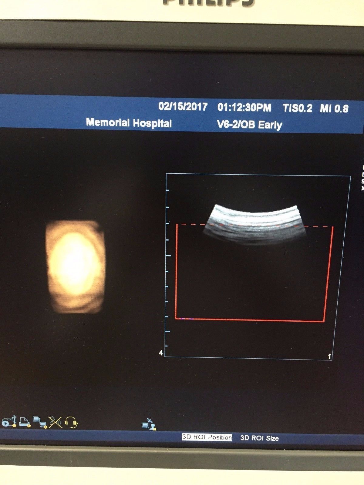 Philips V6-2 Curved Volume Array  Ultrasound Transducer  for Philips iU22 DIAGNOSTIC ULTRASOUND MACHINES FOR SALE