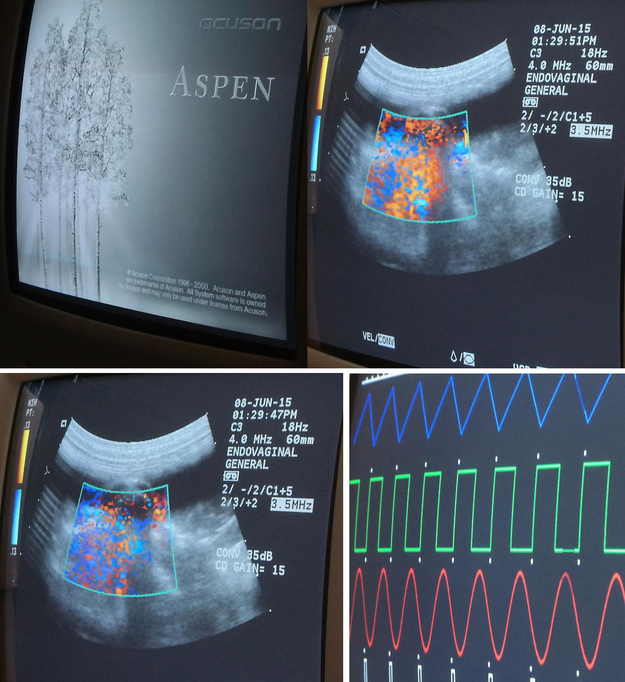 ACUSON ASPEN ADVANCED ULTRASOUND SYSTEM OBGYN RADIOLOGY W/ EVC8 C3 PROBE MACHINE DIAGNOSTIC ULTRASOUND MACHINES FOR SALE