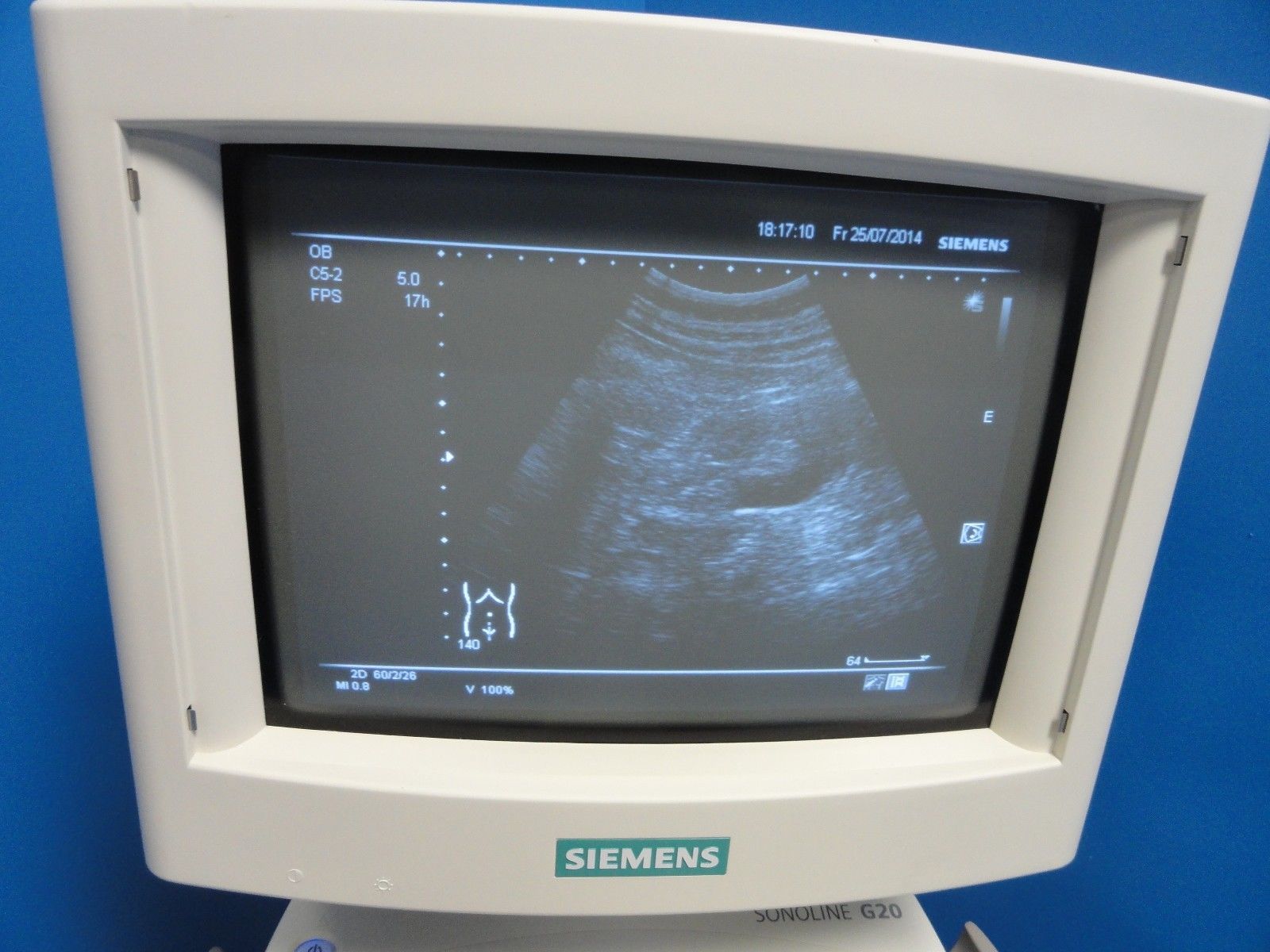 2005 Siemens Sonoline G20 Ultrasound W/ C5-2 Convex Transducer & Printer (6937) DIAGNOSTIC ULTRASOUND MACHINES FOR SALE