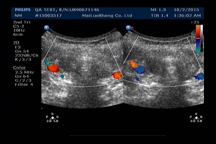 a screen shot of an x - ray of a woman's breast