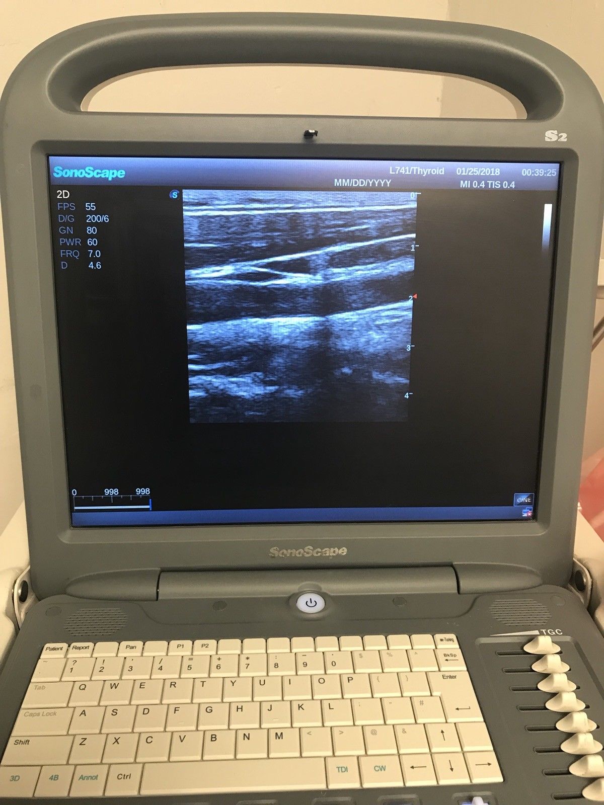 2013 Sonoscape S2 Ultrasound With Vascular, Abdominal Probes DIAGNOSTIC ULTRASOUND MACHINES FOR SALE