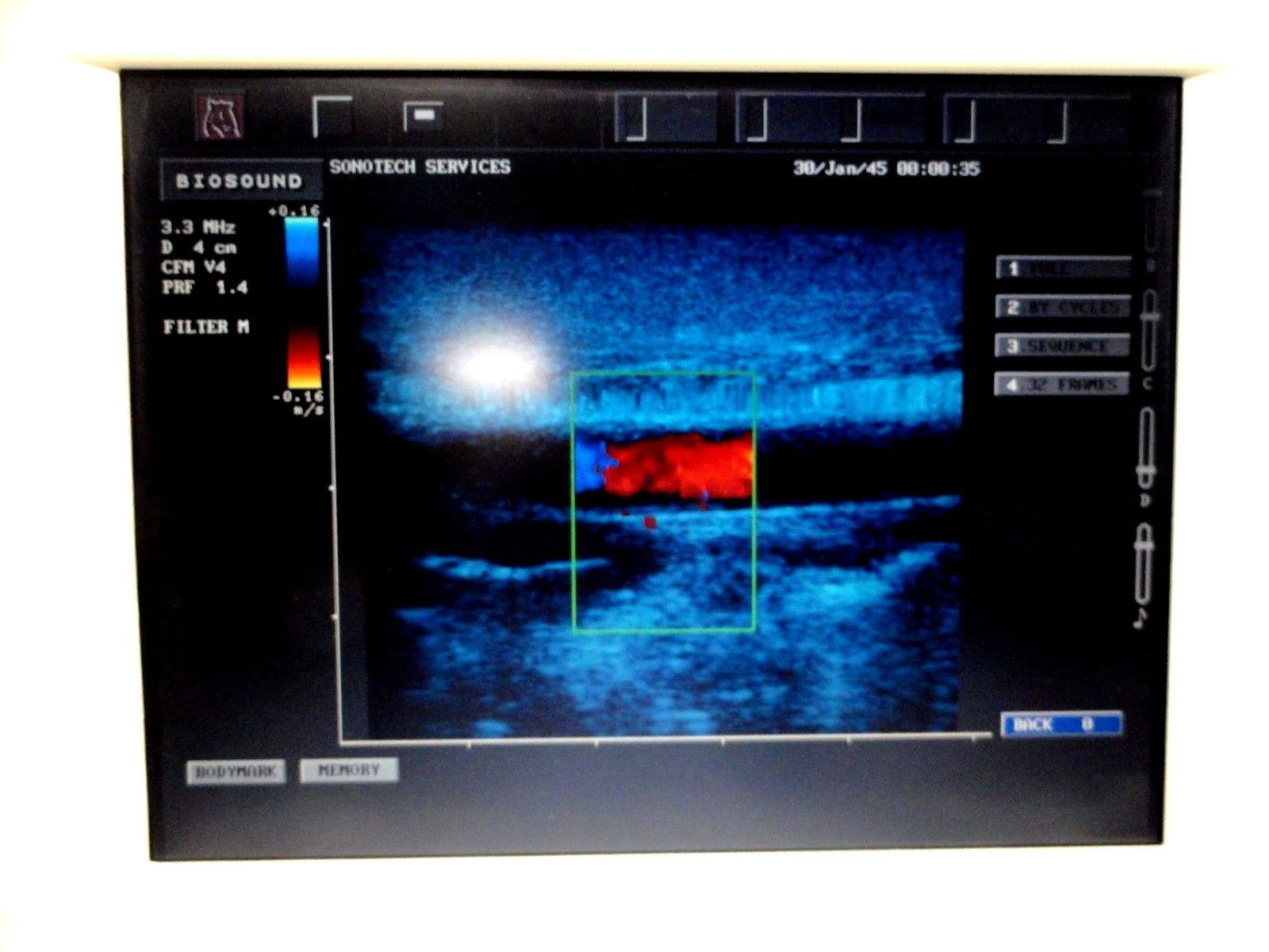 ESAOTE Biosound LA522E Linear Array Ultrasound Probe for MyLab Series ~12899 DIAGNOSTIC ULTRASOUND MACHINES FOR SALE