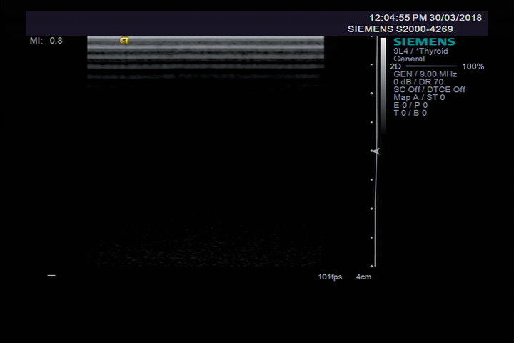 ACUSON 9L4 ULTRASOUND PROBE. REFURBISHED. WORKS FINE DIAGNOSTIC ULTRASOUND MACHINES FOR SALE