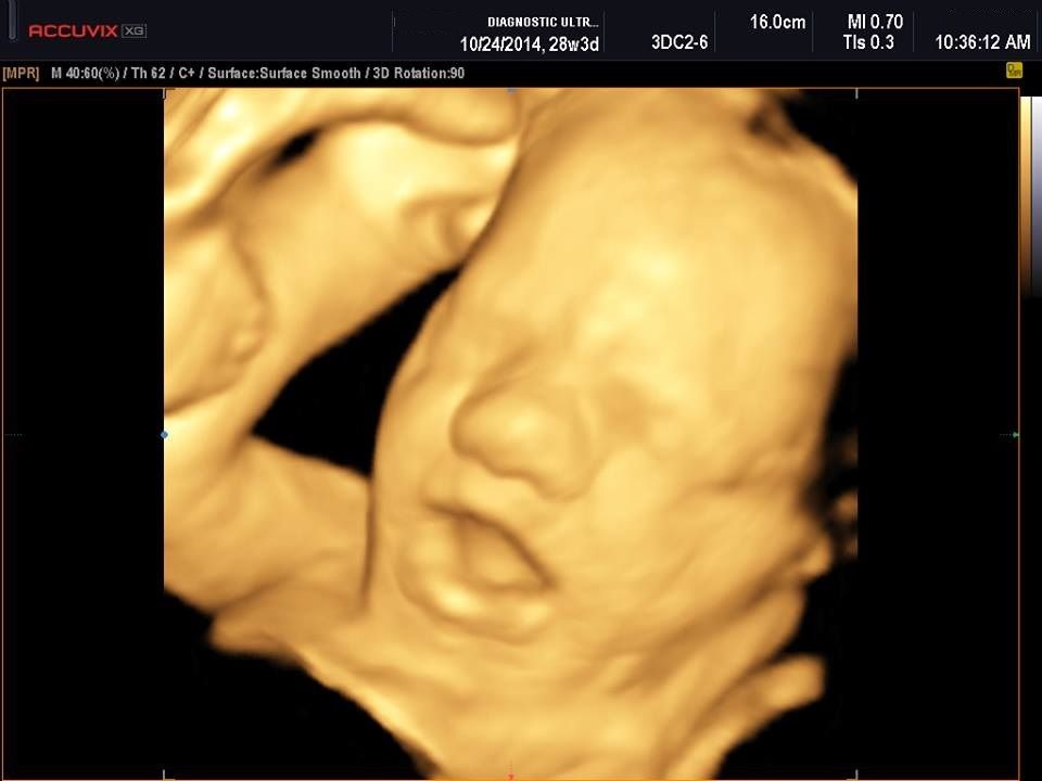 Samsung Medison Accuvix XG with 3D/4D convex probe DIAGNOSTIC ULTRASOUND MACHINES FOR SALE