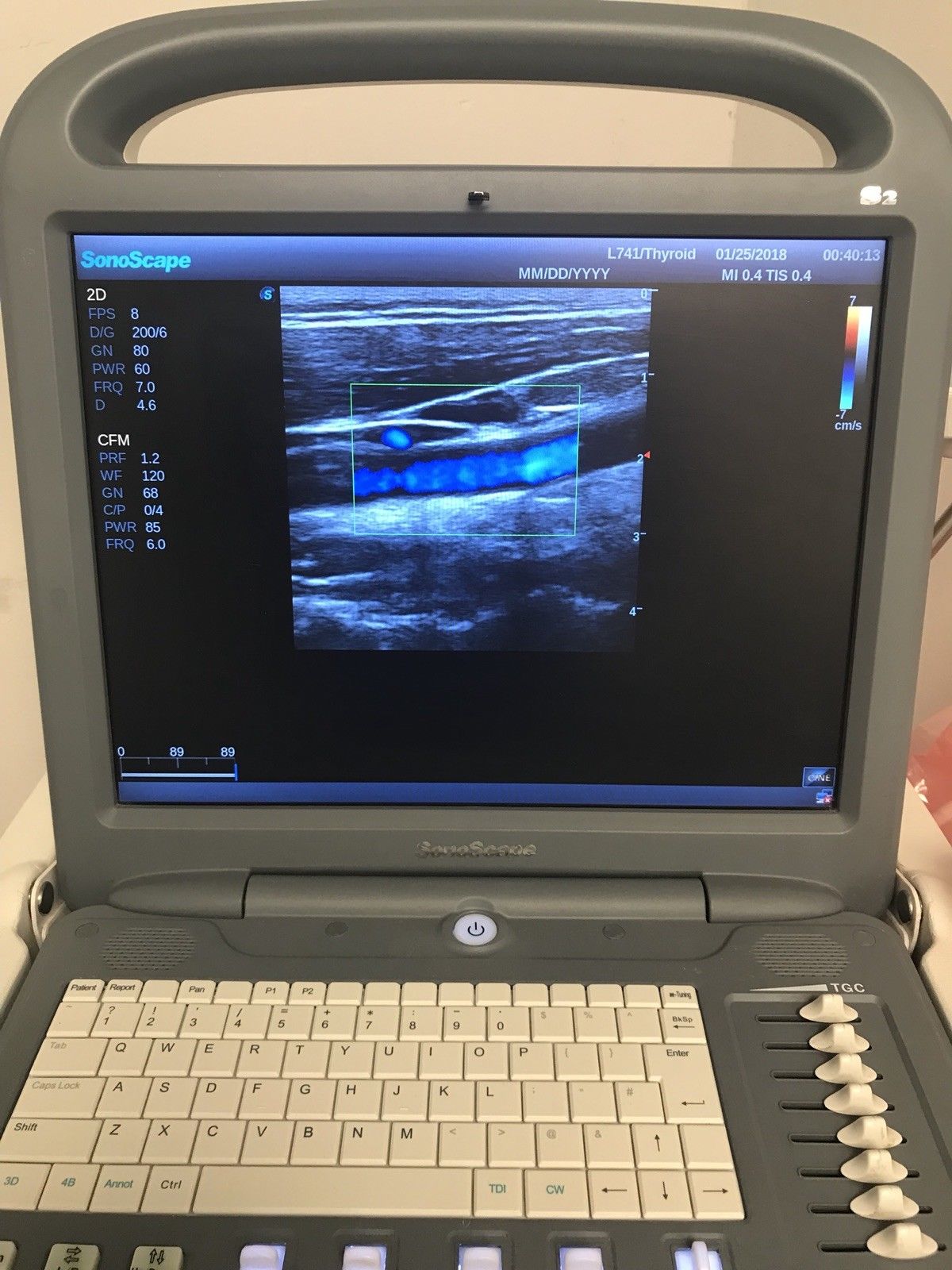 2013 Sonoscape S2 Ultrasound With Vascular, Abdominal Probes DIAGNOSTIC ULTRASOUND MACHINES FOR SALE