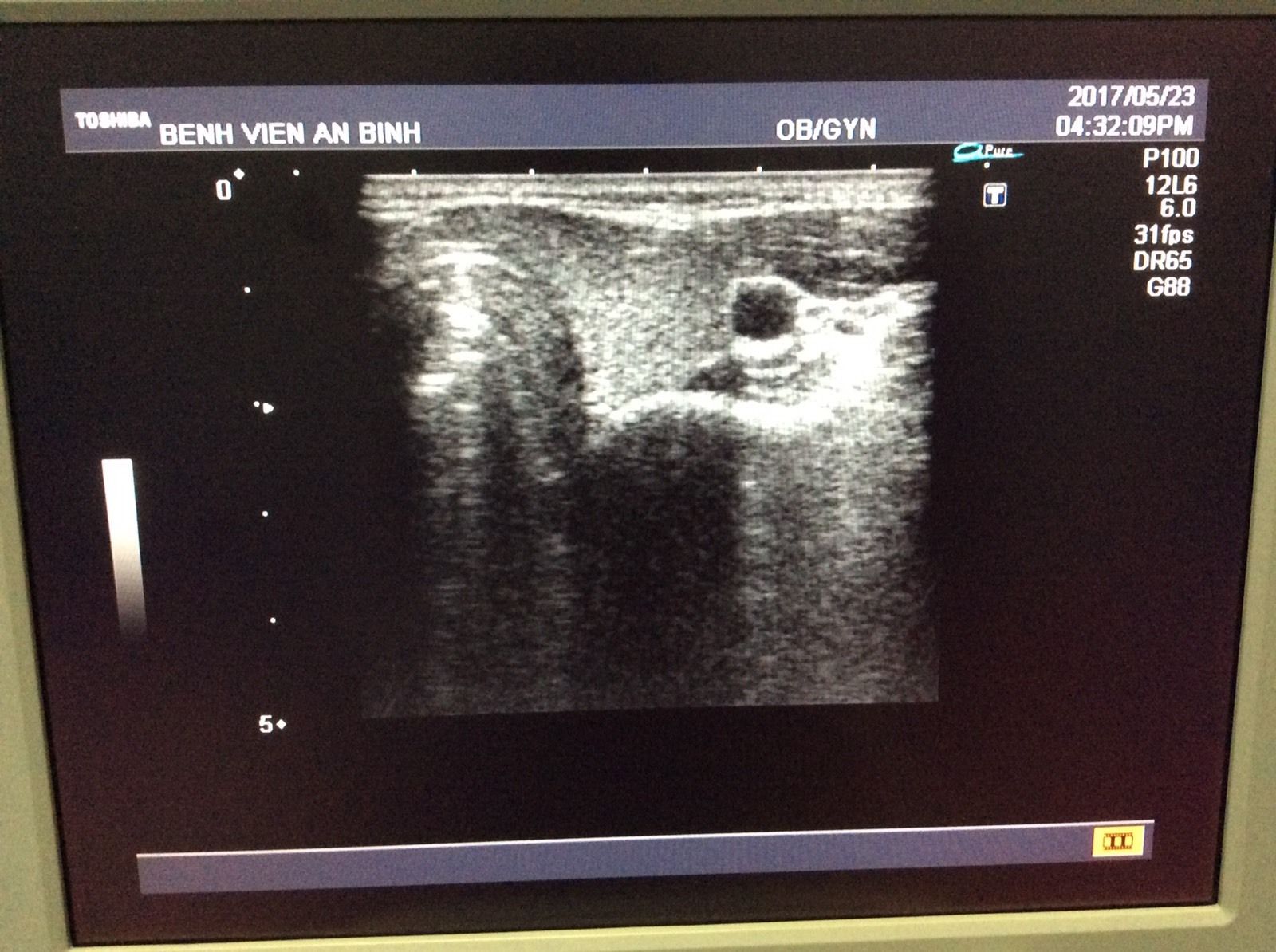 Toshiba Ultrasound transducer probe linear PLM-805AT DIAGNOSTIC ULTRASOUND MACHINES FOR SALE