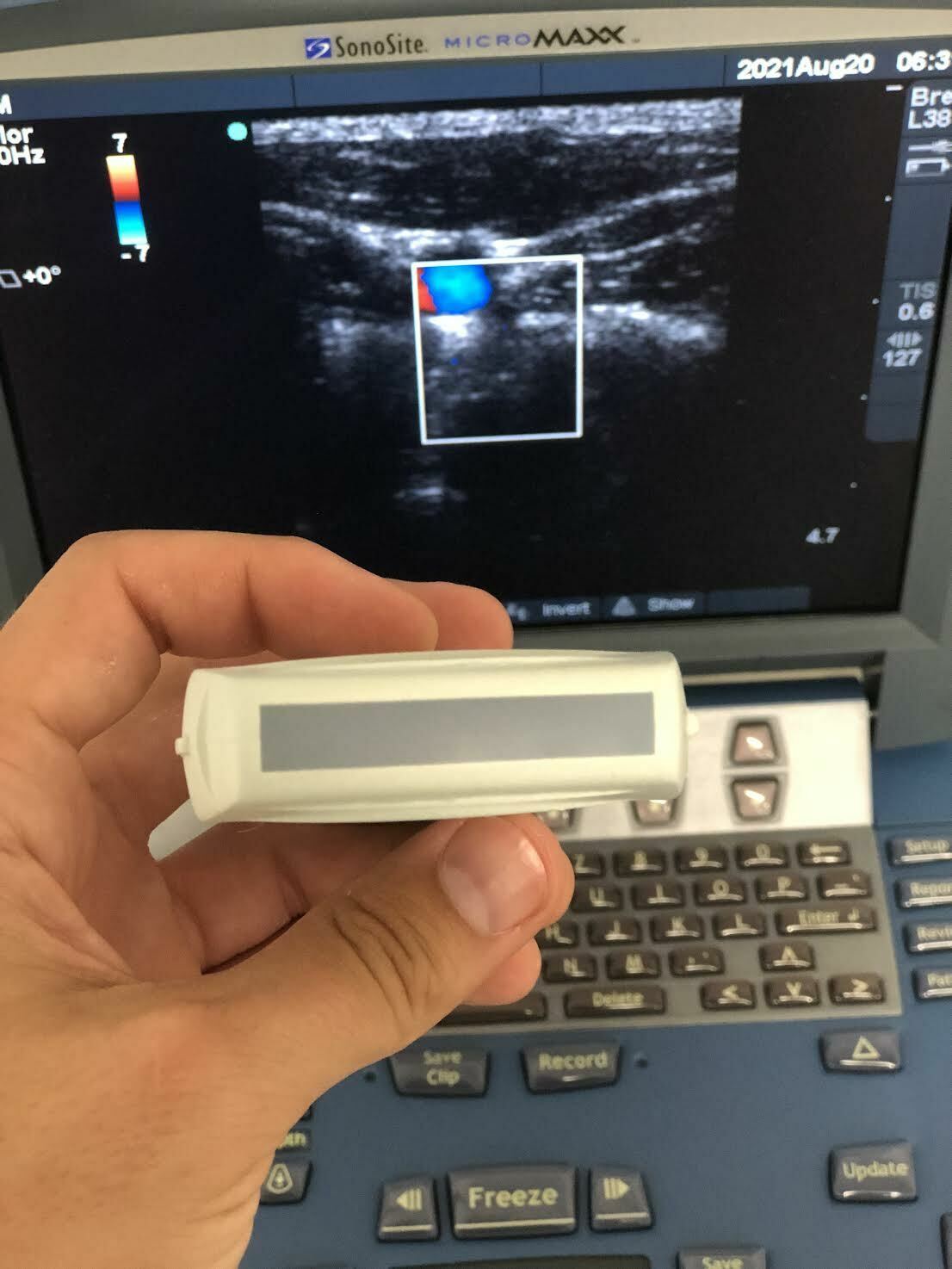 Sonosite Micromaxx Portable Ultrasound Machine with L38e Linear Array Transducer DIAGNOSTIC ULTRASOUND MACHINES FOR SALE