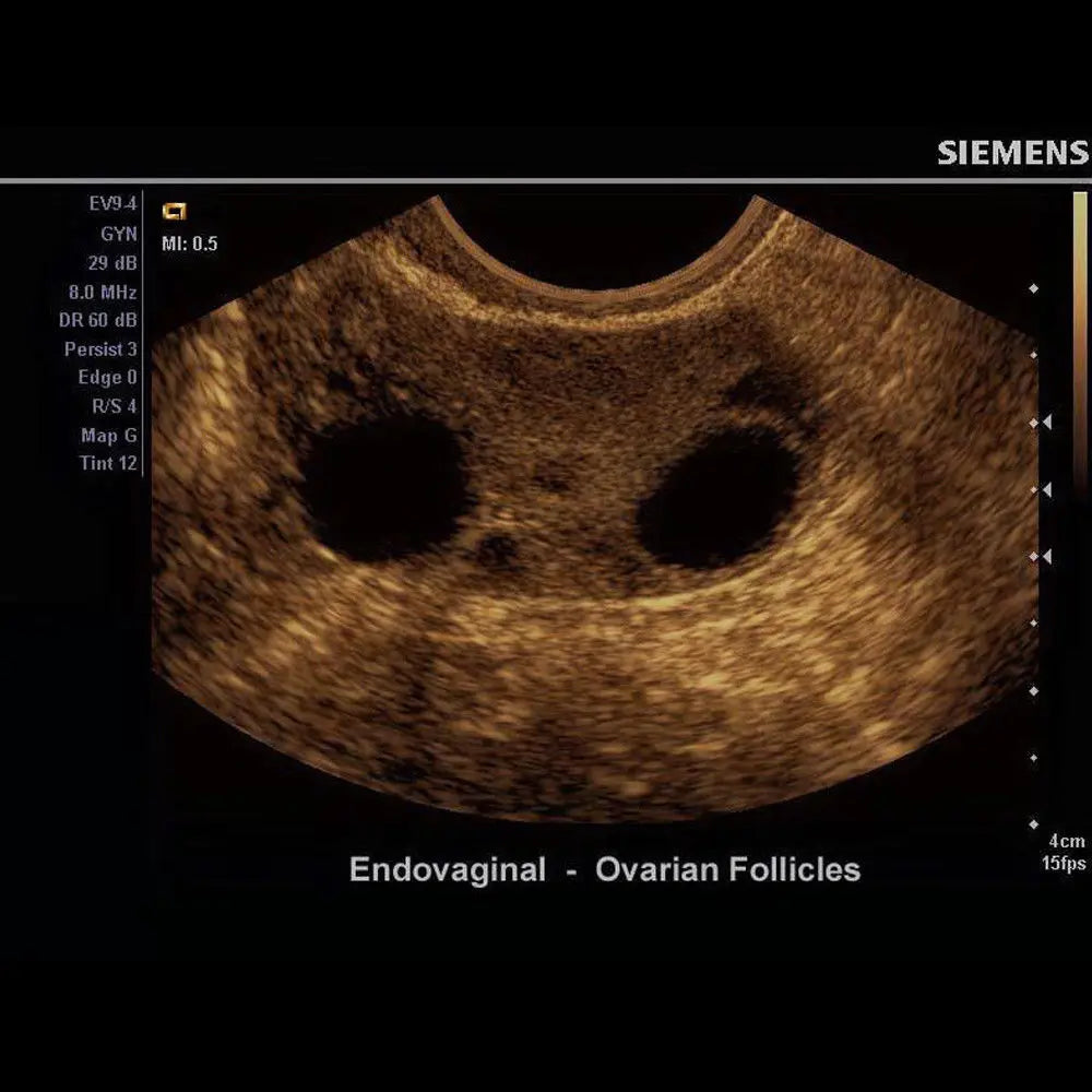 Pulsed Wave Ultrasound - Siemens X150 Machine + Acuson CH5-2 + THI + DICOM DIAGNOSTIC ULTRASOUND MACHINES FOR SALE