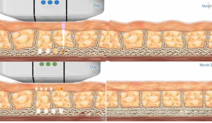 High Intensity Focused Ultrasound Hifu Skin Rejuvenation Anti-Wrinkle Machine DIAGNOSTIC ULTRASOUND MACHINES FOR SALE
