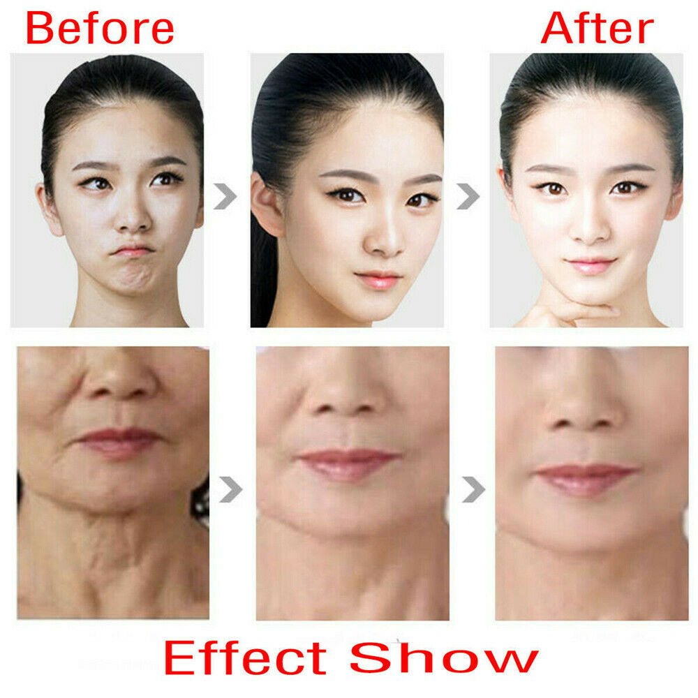 V MAX HIFU Skin Tightening Ultrasound Wrinkle Machine Face Neck Lift Skin Care DIAGNOSTIC ULTRASOUND MACHINES FOR SALE