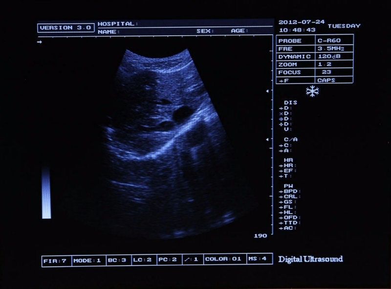 Professional  Full Digital Portable Ultrasound Scanner Convex Linear 2Probes 3D 190891754998 DIAGNOSTIC ULTRASOUND MACHINES FOR SALE