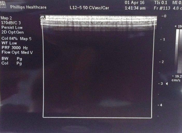 Philips (ATL) L12-5 (50mm) Linear Array Ultrasound Transducer Probe DIAGNOSTIC ULTRASOUND MACHINES FOR SALE