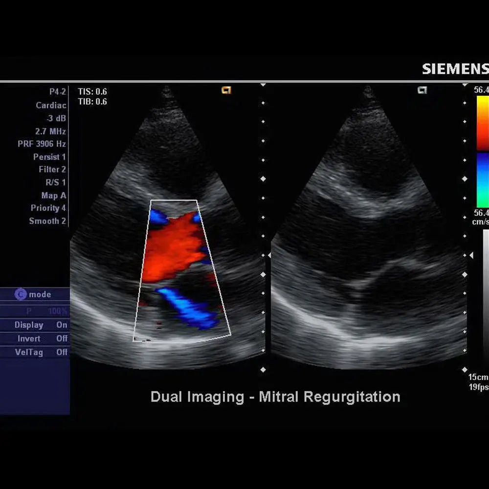 Pulsed Wave Ultrasound - Siemens X150 Machine + Acuson CH5-2 + THI + DICOM DIAGNOSTIC ULTRASOUND MACHINES FOR SALE