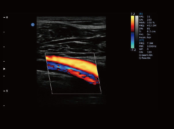 Chison eBit50 Ultrasound Color Doppler Portable Advanced 15" LED Battery 1 Probe DIAGNOSTIC ULTRASOUND MACHINES FOR SALE