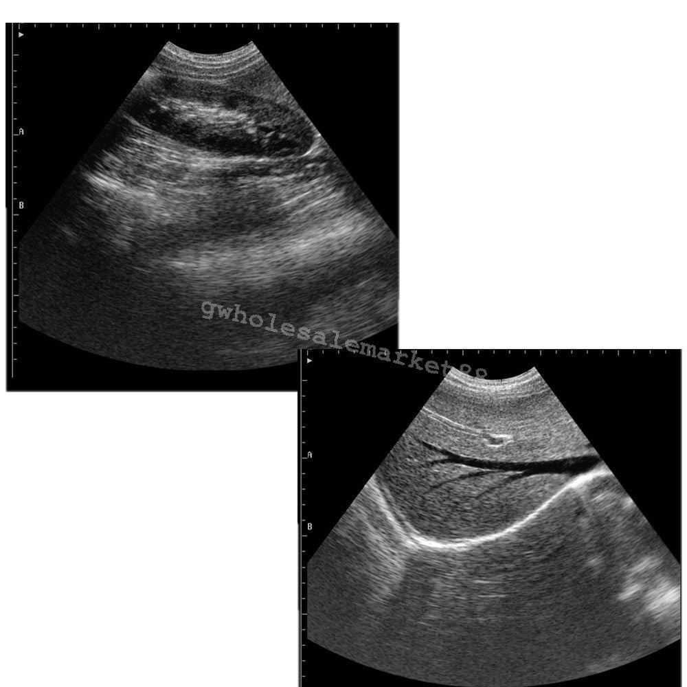 HandScan Full Digital Ultrasound scanner Machine Convex+ Transvaginal probe Case DIAGNOSTIC ULTRASOUND MACHINES FOR SALE