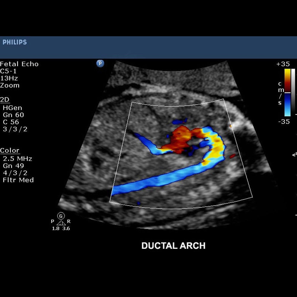 Philips CX50 Portable Ultrasound System with S5-1 Cardiac Sector Transducer DIAGNOSTIC ULTRASOUND MACHINES FOR SALE