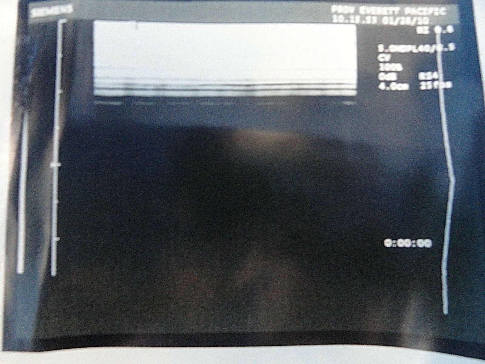 Siemens 5.0HDPL40 Linear Array Ultrasound Transducer for Sonoline Elegra ~15758 DIAGNOSTIC ULTRASOUND MACHINES FOR SALE